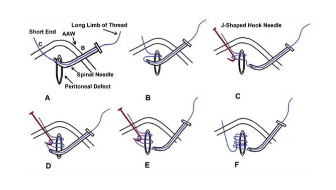 Methods of Suture Attachment to the Needle