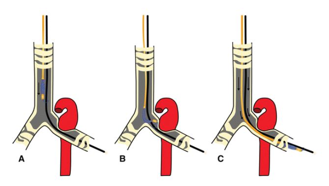 Components of a Bronchial Blocker