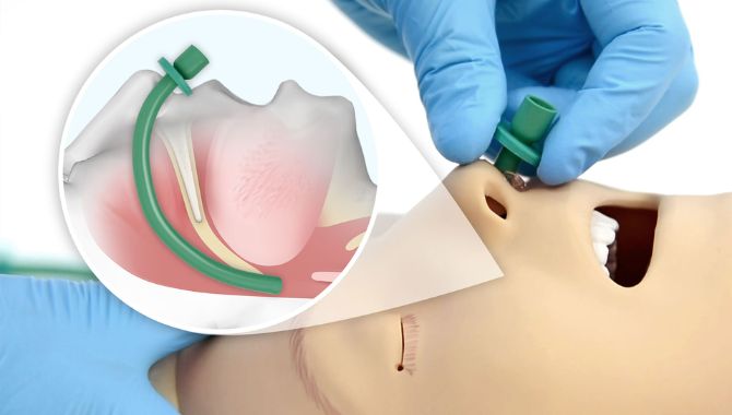 Equipment for Nasopharyngeal Airway