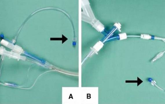 Medico – Reliable Double Lumen Endobronchial Tube Feature Supplier in China